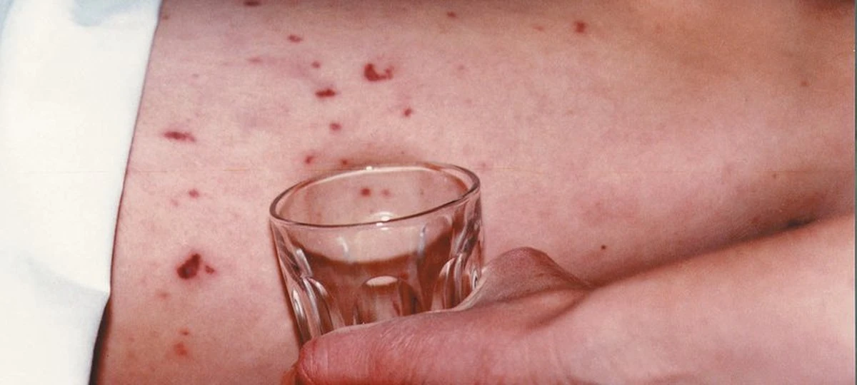 Dlaczego lekarze w Wielkiej Brytanii alarmują o nietypowej 