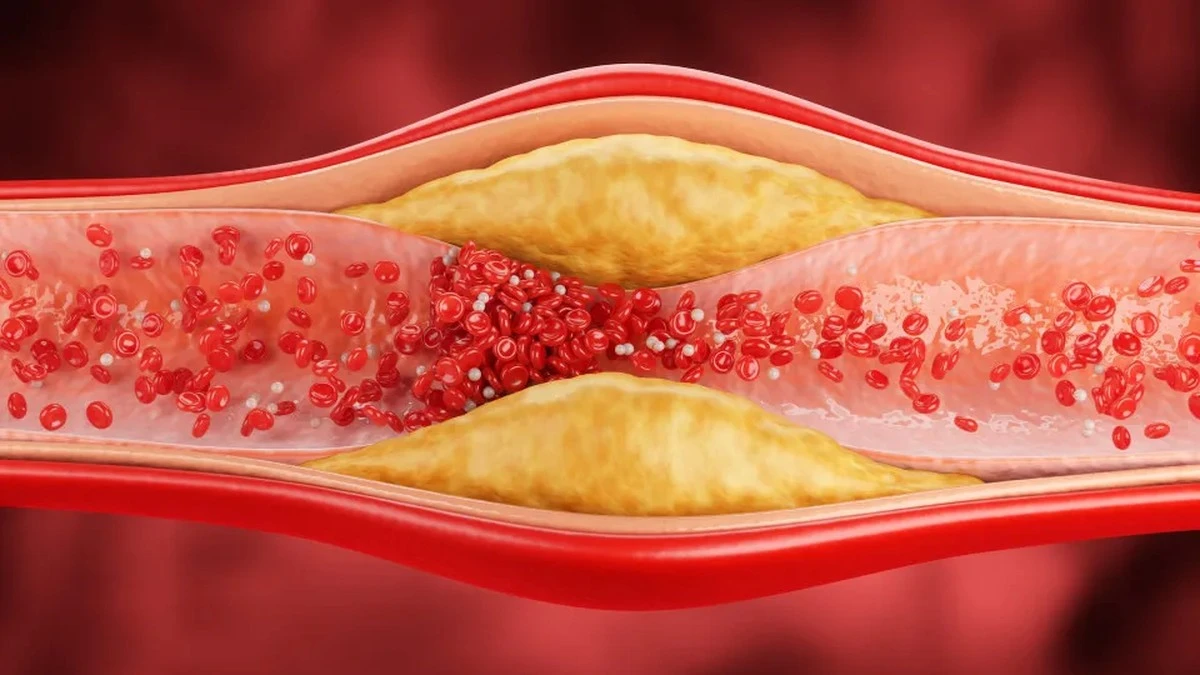 Pięć subtelnych zmian na ciele, które mogą świadczyć o wysokim poziomie cholesterolu